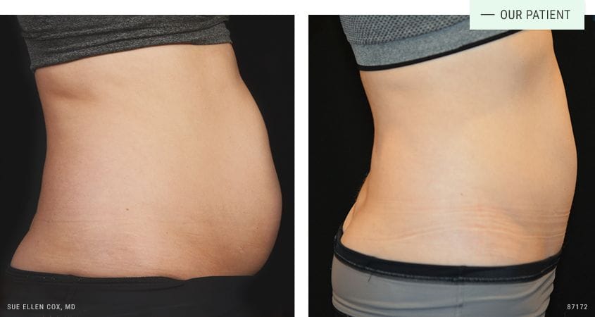 6 Questions You May Have About CoolSculpting - Aesthetic Solutions