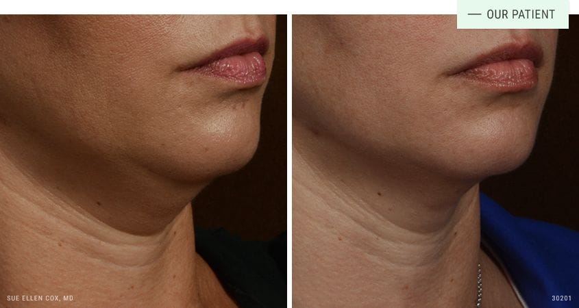 CoolSculpting before and after