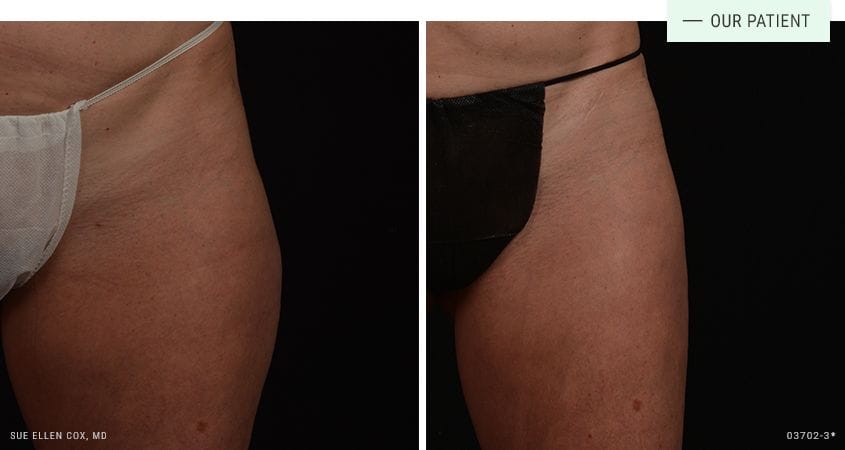 CoolSculpting - Aesthetic Solutions