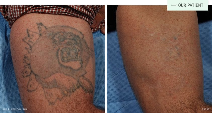 Red/Blue Light Picosecond Laser Tattoo Removal Pen Mole Dark Spot Remover  tool | eBay