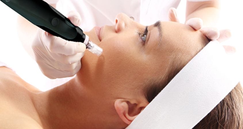 Microneedling treatment on patient