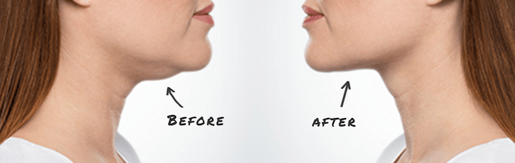 Body Contouring under the chin, before and after