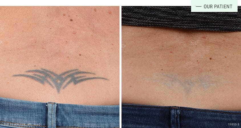 Laser Tattoo Removal: How long until you can see results? — LaserTat